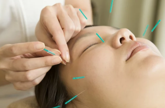 顔への美容鍼施術